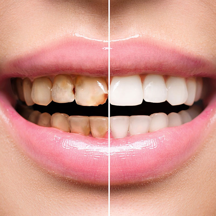 Restaurarea estetică a dinților
